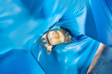 Diş bakımı. Haham kullanarak diş kompozit fotopolimer materyaliyle dolduruluyor. Diş sağlığı kliniğinde diş tedavisi kavramı