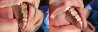 iki çürük tedaviden sonra üst çene yan dişlerin çiğneme. Dolgu lastik baraj sistemiyle Fotopolimer çiğneme yüzeyle restorasyonu