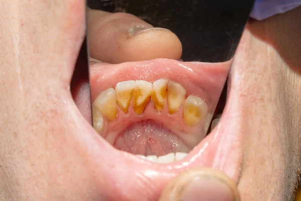 Denti Marci Carie Placca Primo Piano Paziente Asocialmente Malato Concetto — Foto Stock