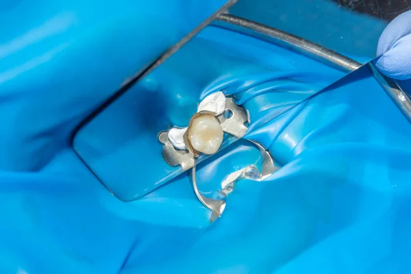 Два Жевательных Боковых Зуба Верхней Челюсти После Лечения Кариеса Восстановление — стоковое фото
