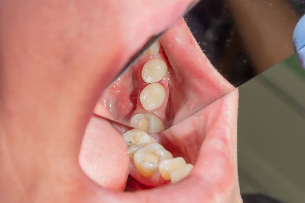Des Caries Dentaires Remplissage Avec Matériau Photopolymère Composite Dentaire Aide — Photo