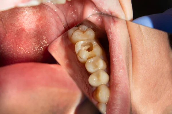 Dois Dentes Laterais Mastigatórios Mandíbula Superior Após Tratamento Cárie Restauração — Fotografia de Stock