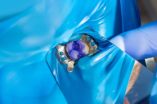 Dental Caries Filling Dental Composite Photopolymer Material Using Rabbders Concept — Stock Photo, Image
