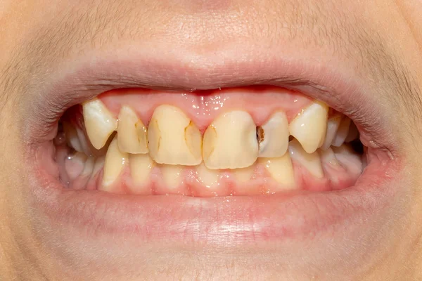 Dentes Podres Cárie Placa Close Paciente Asocialmente Doente Conceito Higiene — Fotografia de Stock