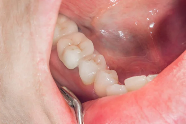 Dental Restoration Rotten Roots Teeth Ceramic Crowns Cast Posts Dentistry — Stock Photo, Image