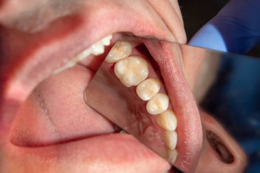 Diş tedavisi diş kliniği. Carious çürük diş yakın çekim makro. Endodontik kanallar tedavisinde