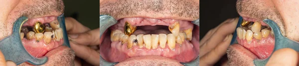 Dents Pourries Caries Plaque Gros Plan Chez Patient Gravement Malade — Photo