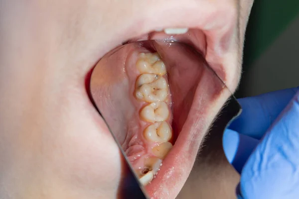 Dental treatment in the dental clinic. Rotten carious tooth close-up macro. Treatment of endodontic canals