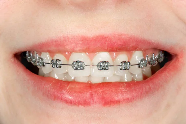 Frenos dentales primer plano durante el tratamiento en un ortodoncista. Aest. —  Fotos de Stock