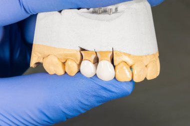 dişlerin bir sıva modeli üzerinde yakın çekim seramik diş tacı 