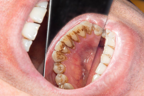 human teeth with smoking plaque and tartar. Close-up macro in de