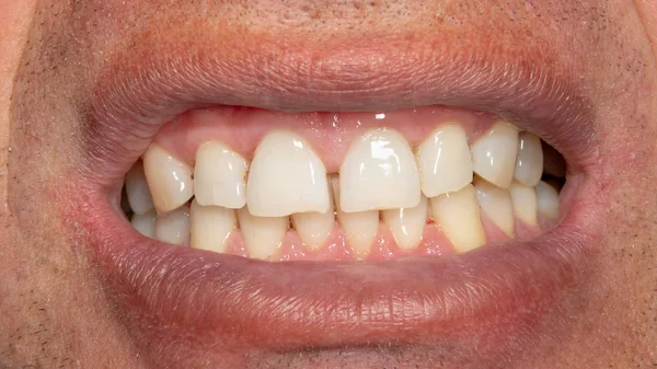 धूम्रपान पट्टिका और तीखा के साथ मानव दांत। डी में क्लोज-अप मैक्रो — स्टॉक फ़ोटो, इमेज