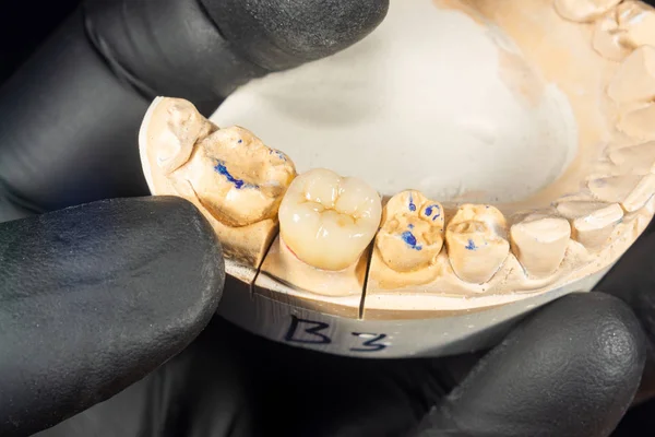 close-up ceramic tooth crown on a plaster model of teeth in the