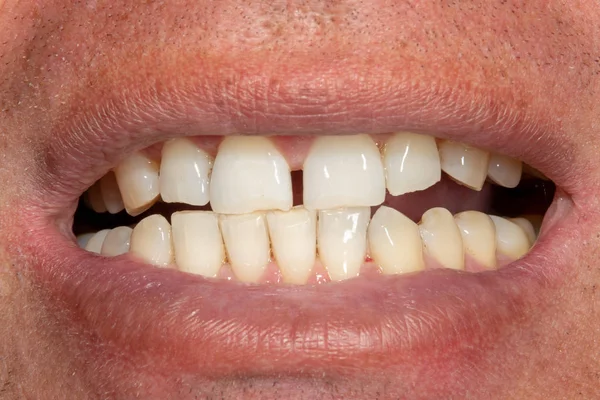 Primer plano de los dientes después de la higiene y el blanqueamiento. El rostro y la sonrisa del hombre —  Fotos de Stock