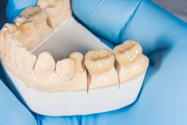 ceramic crowns veneers on a gypsum model of human teeth close-up