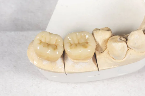 Ceramic crowns veneers on a gypsum model of human teeth close-up — 스톡 사진