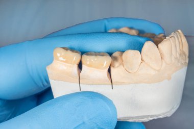 bir dentis elinde yakın çekim insan dişlerinin zirkonyum kron