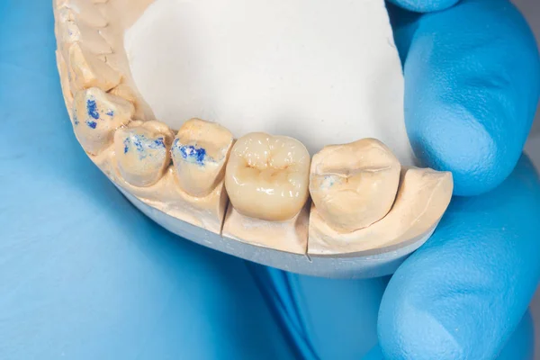 J의 석고 모델에 클로즈업 치아의 모든 세라믹 크라운 — 스톡 사진