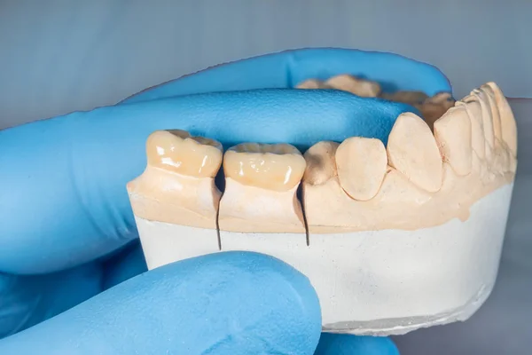Zirkonium kronen van menselijke tanden close-up in de hand van een dentis — Stockfoto