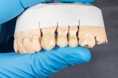 bir dentis elinde yakın çekim insan dişlerinin zirkonyum kron