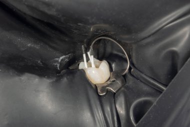 Periodontit isi bir insan dişi. Den endodonti tedavisi