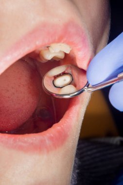 insan dişlerinin seramik kron closeup makro siyah bac izole