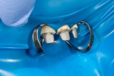 bir alçı modeli yakın çekim bir insan diş metal döküm pin 