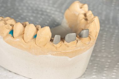 Seramik diş kronve metal pimleri yakın çekim makro. Ortopedik d