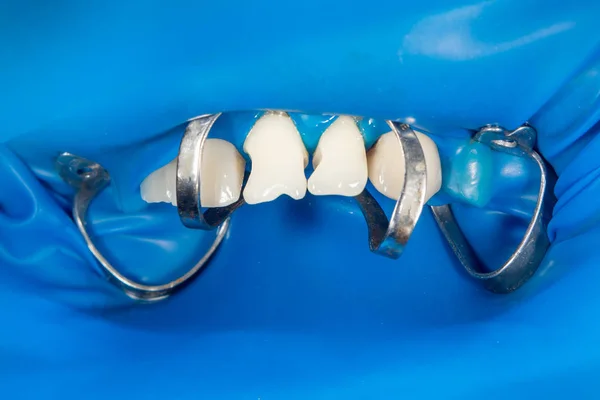 Відновлення зубів людини, уражених карієсом з фотополімером — стокове фото