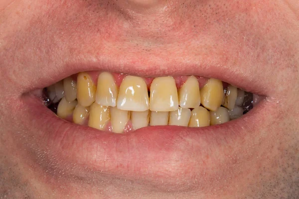 Smoking, plaque on teeth — Stock Photo, Image