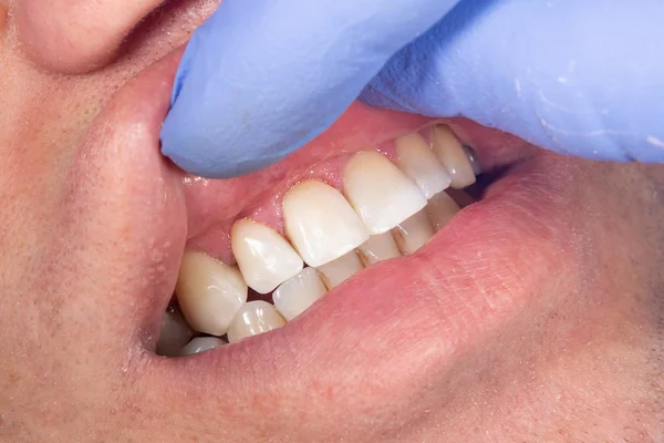 Lidský zub se blíží k zubaři. Chudý nebo — Stock fotografie