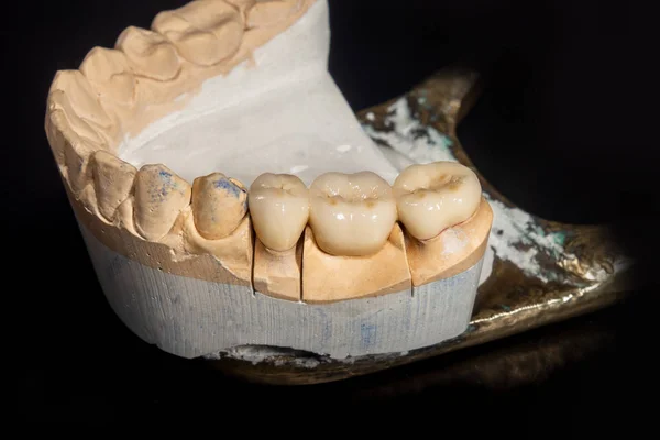 ceramic crowns of human teeth closeup macro isolate on black bac