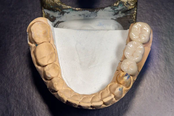 Keramische kronen van menselijke tanden close-up macro isoleren op zwarte BAC — Stockfoto