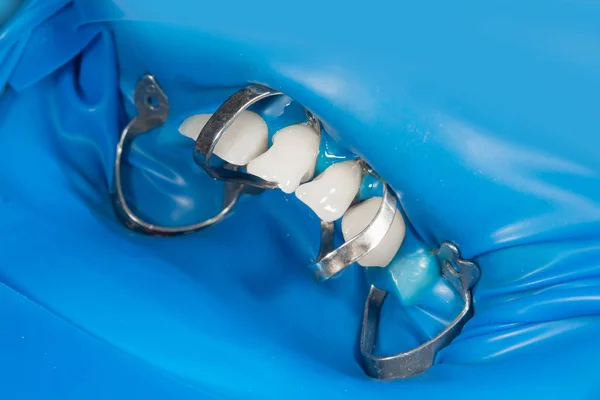 Restauración de dientes humanos afectados por caries con fotopolímero — Foto de Stock