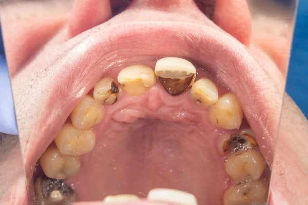 人类蛀牙特写在牙医的预约。差或 — 图库照片