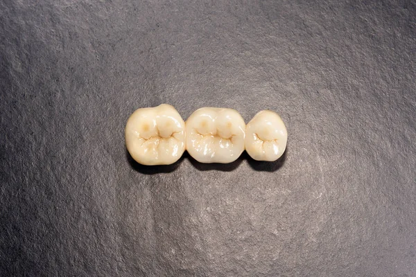 치아 클로즈업 m의 치과 베니어, 세라믹 및 지르코늄 크라운 — 스톡 사진