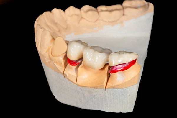 Kerámia fog koronák és fém csapok közeli makró. D. ortopéd — Stock Fotó