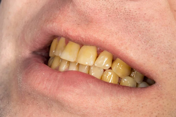 Smoking, plaque on teeth — Stock Photo, Image
