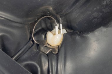 Diş köklerinin endodontik tedavisi yakın çekim makro. Minber 