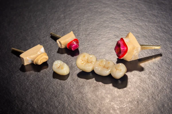 Ceramiczne Korony zębów i metalowe szpilki zbliżenie makro. Ortopedyczne d — Zdjęcie stockowe