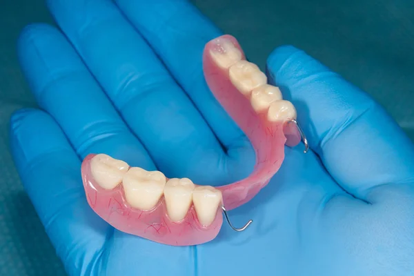 Dentadura. Dentadura parcialmente removível da mandíbula inferior de uma pessoa — Fotografia de Stock