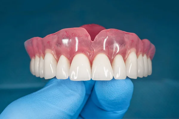 Dentadura. Dentadura removível completa da mandíbula superior de um homem com w — Fotografia de Stock