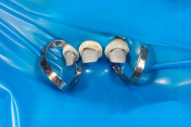 Seramik diş kronve metal pimleri yakın çekim makro. Ortopedik d