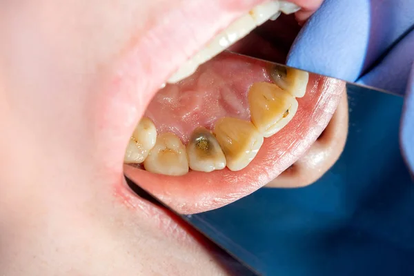 Two chewing side teeth of the upper jaw after treatment of carie — Stock Photo, Image