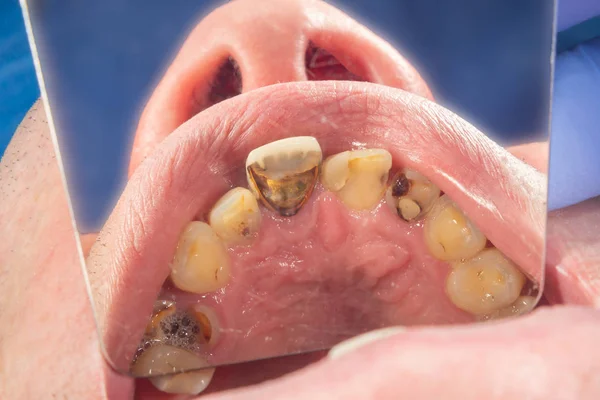 Ceramic tooth crowns and metal pins close-up macro. Orthopedic d