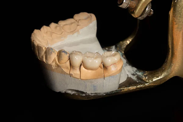 Tandheelkundige veneers, keramiek en zirkonium kronen van tanden close-up m — Stockfoto