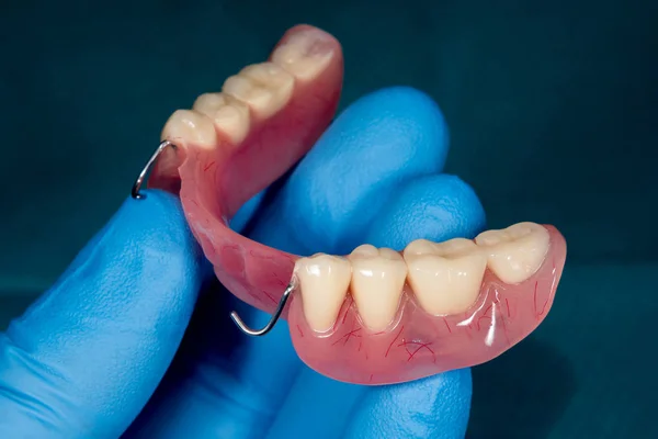 Dentadura. Dentadura parcialmente removível da mandíbula inferior de uma pessoa — Fotografia de Stock