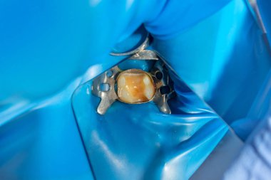 Carie tedaviden sonra üst çenenin iki diş çiğnemesi