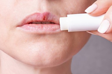 bir kadının yüzü, herpes dilinde, güzellik kavramı parçası