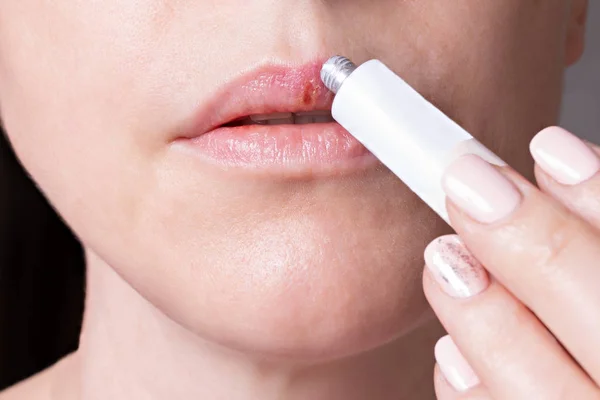 Herpes en los labios de la joven. La mujer lubrica el ungüento labial del herpes —  Fotos de Stock